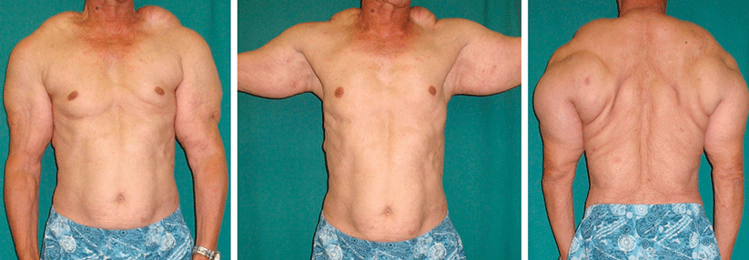 Keine Muskelmasse, sondern zu viel Fett: Bei Erstvorstellung präsentierte sich der 61-Jährige mit symmetrischen, schmerzlosen Weichteilschwellungen.