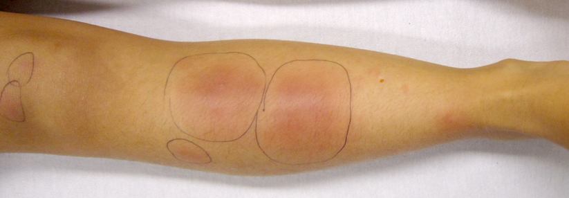 Die Erythema nodosum als wohl bekannteste Form der Pannikulitis äußert sich in roten Flecken auf der Haut.
