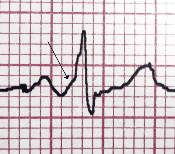 Eine Deltawelle im Sinusrhythmus hingegen ist charakteristisch für die AV-Reentry-Tachykardie.