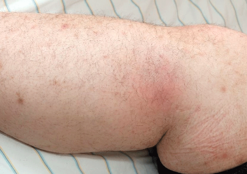 Zusätzlich identifizierten die Kollegen ein Erythema nodosum am Unterschenkel.