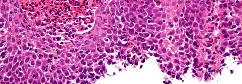 Klassisches Bild einer eosinophilen Ösophagitis: zahlreiche eosinophile Granulozyten und eine Basalzellhyperplasie.
