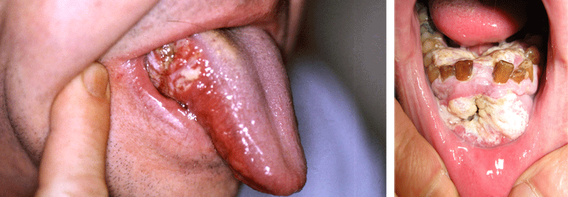 Ein orales Karzinom erscheint zunächst meist als weißes, verdicktes Gewebe. Oft ist der Zungenrand betroffen, dann breitet es sich weiter aus.