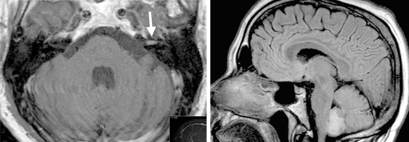 Wegen vestibulärem Schwindel und Hörsturz wurde eine 42-Jährige vorstellig. Ursache war ein kleines in­trameatales Akustikusneurinom (links). Bei einem 38-Jährigen mit heftigem Drehschwindel, Übelkeit und Erbrechen fand sich im MRT ein Kleinhirn-Infarkt (rechts).