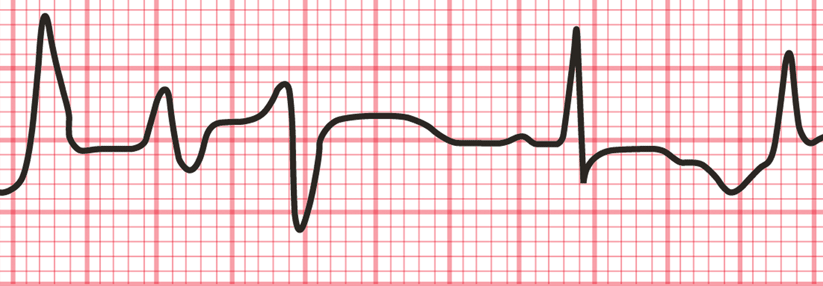 Medikamente, die die QT-Zeit im EKG verlängern, können zu ventrikulären Rhythmusstörungen wie Torsades de Pointes führen.