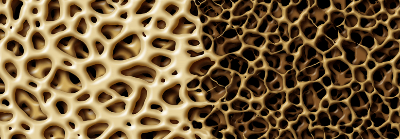 Unter antihormoneller Therapie werden Knochen häufig porös.