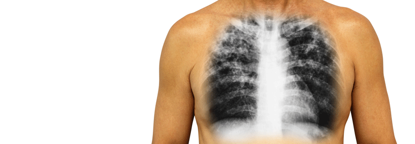 Allein auf den Tiffeneau-Index sollte man sich bei der Diagnose einer COPD nicht verlassen.