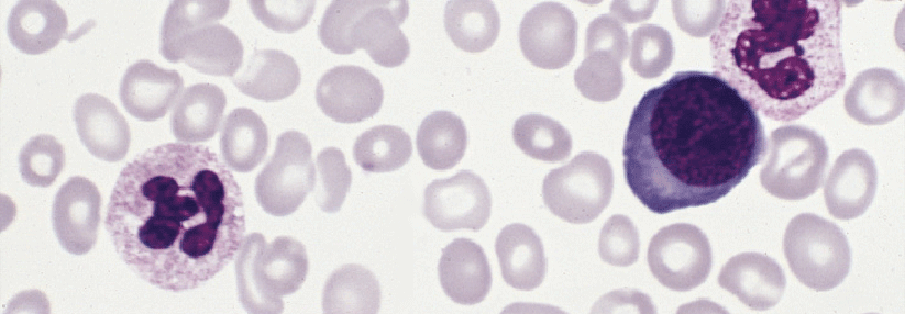Bei PV und ET kommt es zur klonalen Proliferation myeloider Zellen.