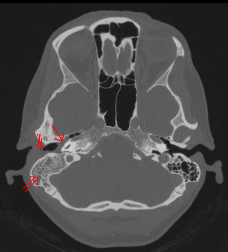 Otitis media (einfacher Pfeil) und Mastoiditis (Doppelpfeil) der rechten Seite (linke Seite im Bild). Der äussere Gehörgang ist teilweise von einer Eiterung (Dreifachpfeil) besetzt. 