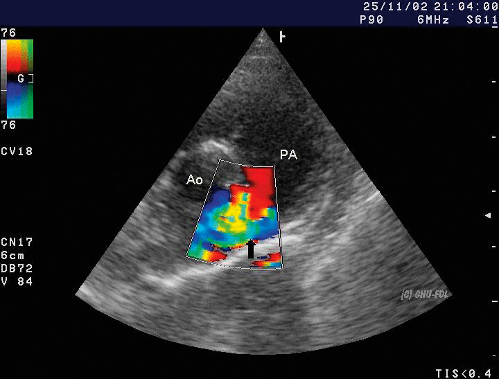 Persistierender Ductus arteriosus. PA: Pulmonalarterie, Ao: Aorta, Pfeil: Etwa hier liegt das Shuntgefäß.