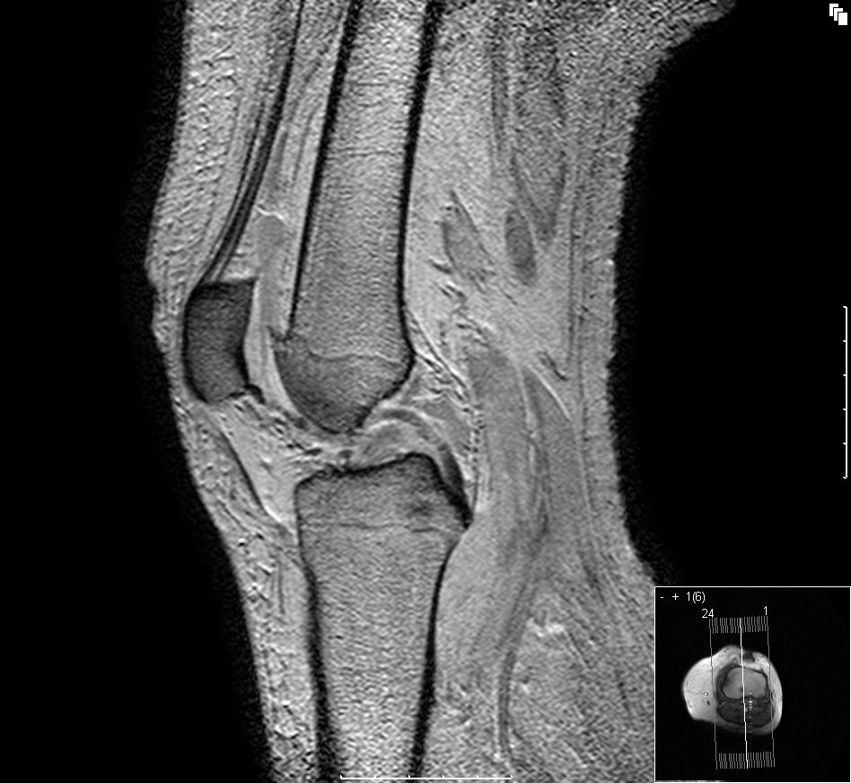 Arthrosebedingte Knochenschäden im Knie