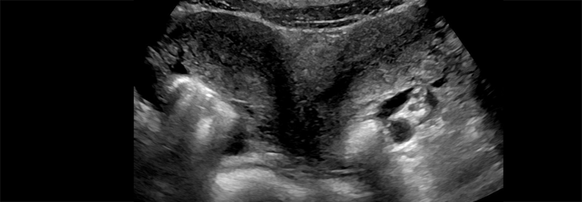 Einen Uterus duplex kann man nur in der Sono-Frontalansicht erkennen.