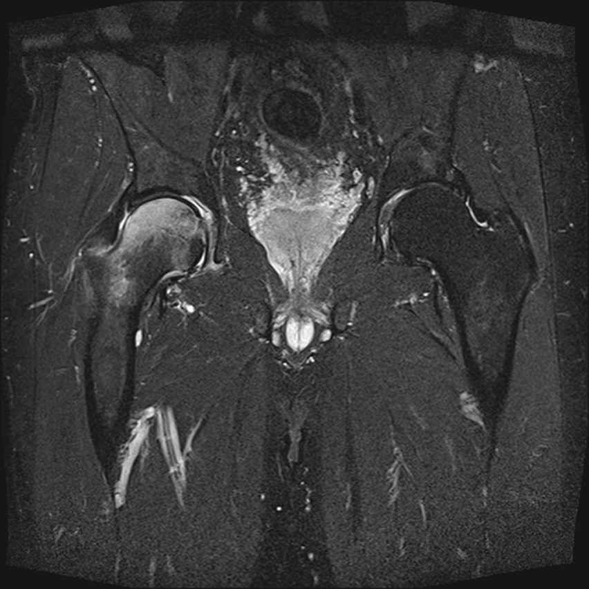 Am rechten Femurkopf zeigt sich im MRT ein transientes Knochenmarködemsyndrom, das bis in den Schenkelhals reicht.