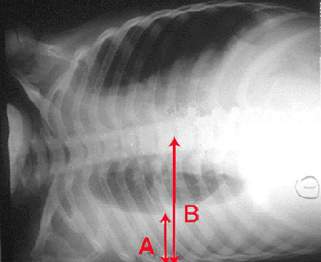 Röntgenbild eines Pleuraergusses: A: Flüssigkeit und B: Pleurahöhle