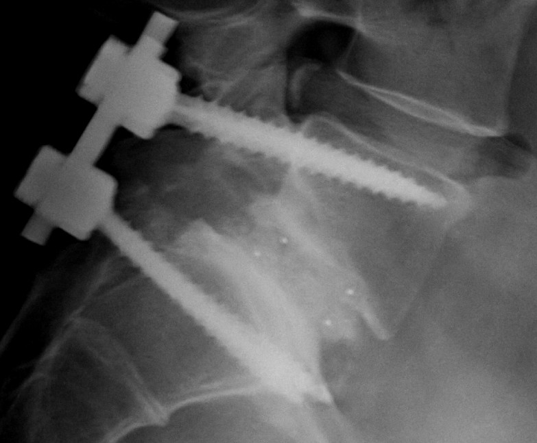 Operative Behandlung des Wirbelgleitens.