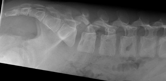 Spondylolyse L5/S1 bei einem elf Jahre alten Jungen.