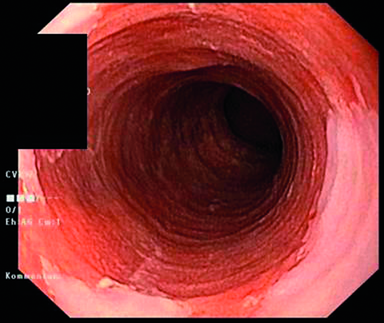 Das Barrett-Ösophagus vor der Ablation.