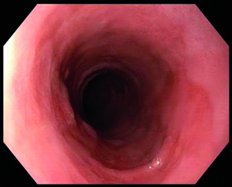 Und die Speiseröhre drei Monate nach Ablation mit stattgehabter Reepithelialisierung.