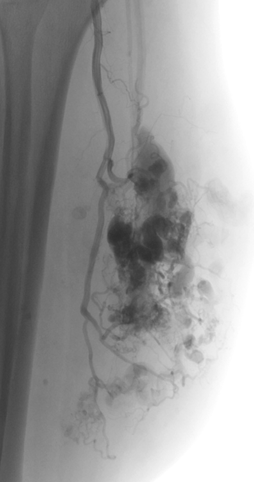 Die arteriovenöse Malformation in der Wade eines 58-Jährigen wurde mittels Flüssigembolisat behandelt.