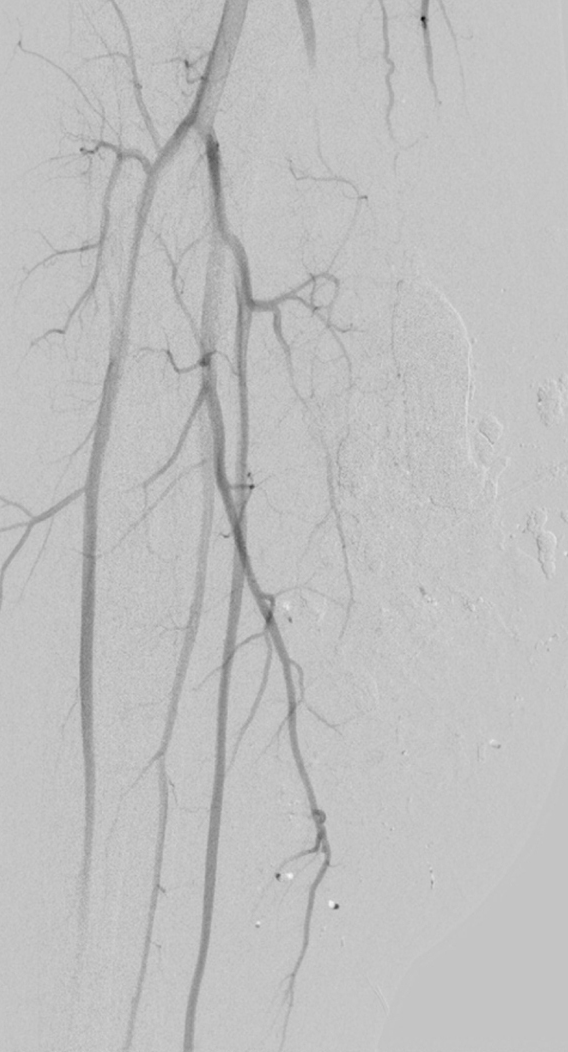 Die arteriovenöse Malformation in der Wade eines 58-Jährigen wurde mittels Flüssigembolisat behandelt.