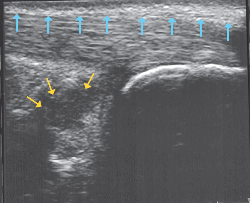 Sonographie der rechten, von einer Insertiontendinopathie betroffenen
Achillessehne: Unter der anti-TNF-Behandlung besteht weiterhin die Bursitis subachillea (blaue Pfeile), in den präachillaren Weichteilen ist Flüssigkeit eingelagert (gelbe Pfeile). Das Paratenon (oben waagerecht) ist verdickt.