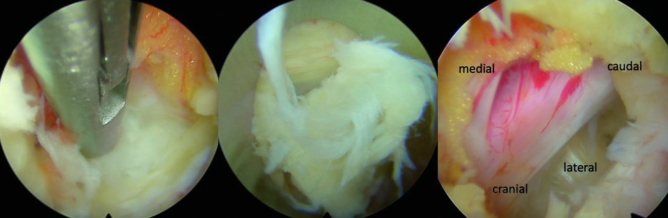 Über das Kamerasystem hat der Chirurg alles im Blick. Der Eingriff wird unter ständigem Flüssigkeitsstrom durchgeführt. Am Ende hat man freie Sicht auf den Spinalnerv.