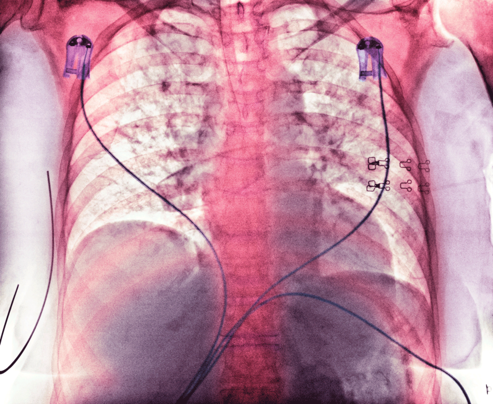 In der kolorierten Röntgenthoraxaufnahme einer 76 Jahre alten Patientin mit Hirnblutung zeigt sich eine Aspirationspneumonie (dunkle Bereiche).