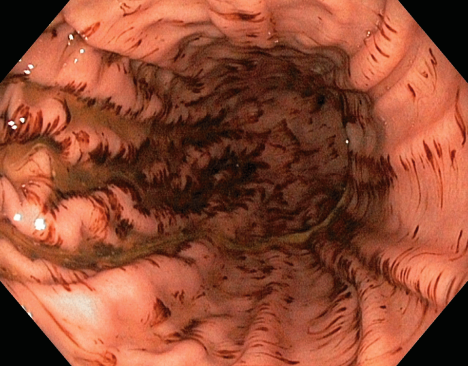 Erosive Gastritis