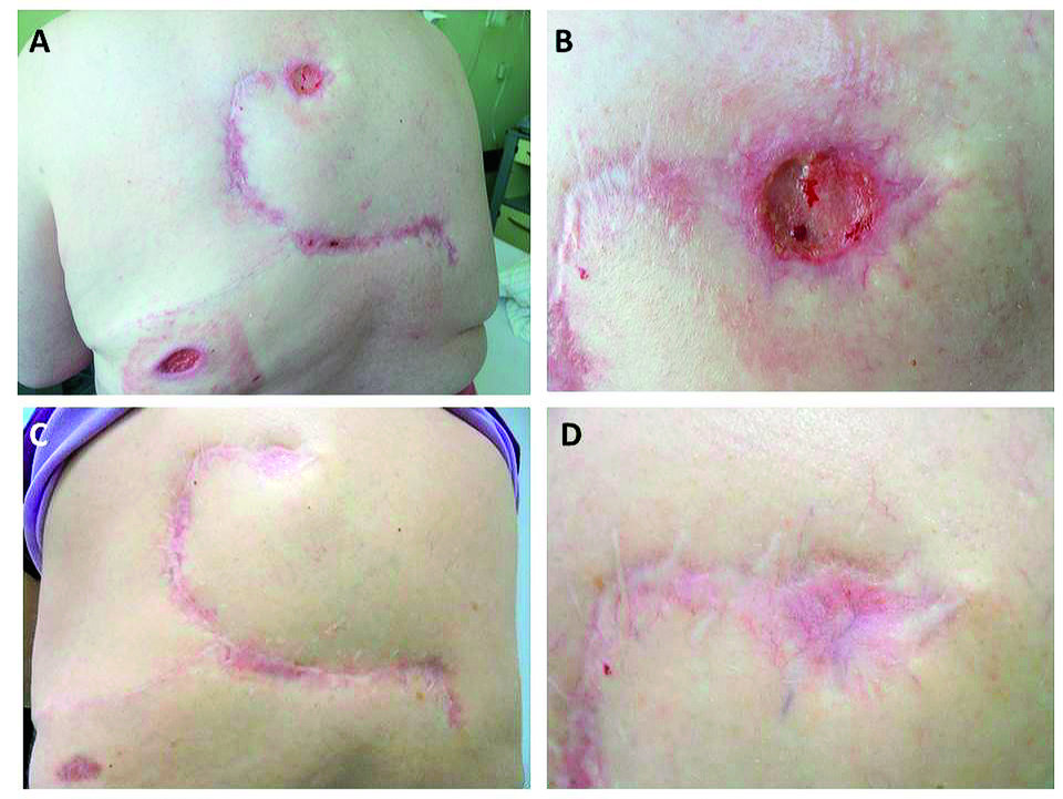 A und B: So kann ein Pyoderma gangraenosum aussehen: Diese Ulzera im Narbenbereich entwickelten sich nach der Rotationslappenplastik. C und D: Nach der immunsuppressiven Therapie ist dieselbe Narbe gut verheilt.