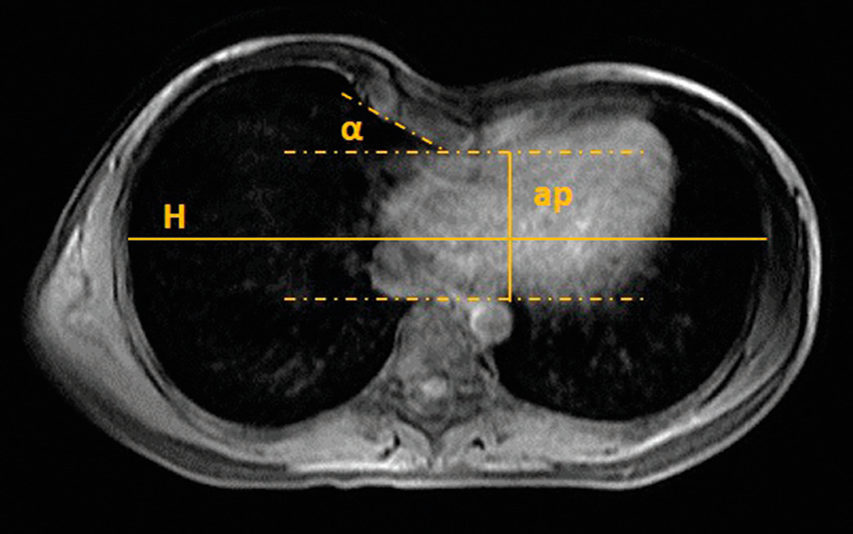 Trichterbrust im MRT: Eingezeichnet sind die Hilfslinien zur Berechnung des Haller-Index und des Sternum-Winkels (α). Der Haller-Index berechnet sich als HI=H/ap, in diesem Beispiel liegt er bei 4,3.