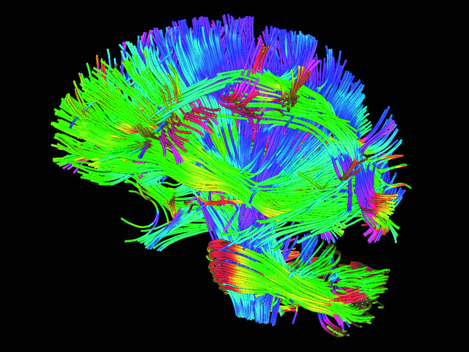 Beispielhafte Darstellung der Nervenbahnen der weißen Hirnsubstanz mittels MRT (Diffusion Tensor Imaging).