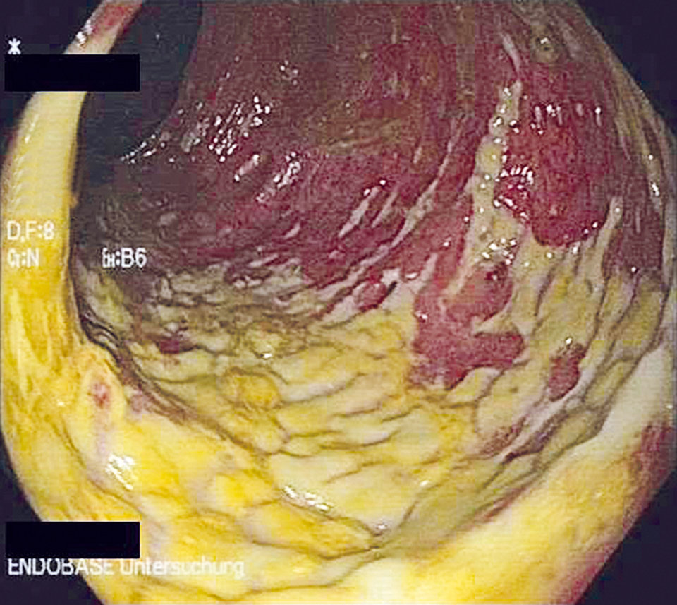 Klassischer endoskopischer Befund einer C.-difficile-Infektion mit Pseudomembranen.