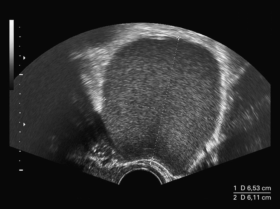 Mittels Sonographie lässt sich eine Endometriose-Zyste detektieren.