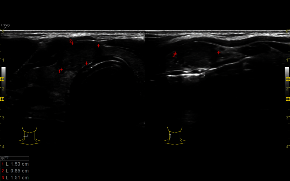 Im Ultraschall des Halses fiel ein auf die Schilddrüse begrenzter Knoten auf. 