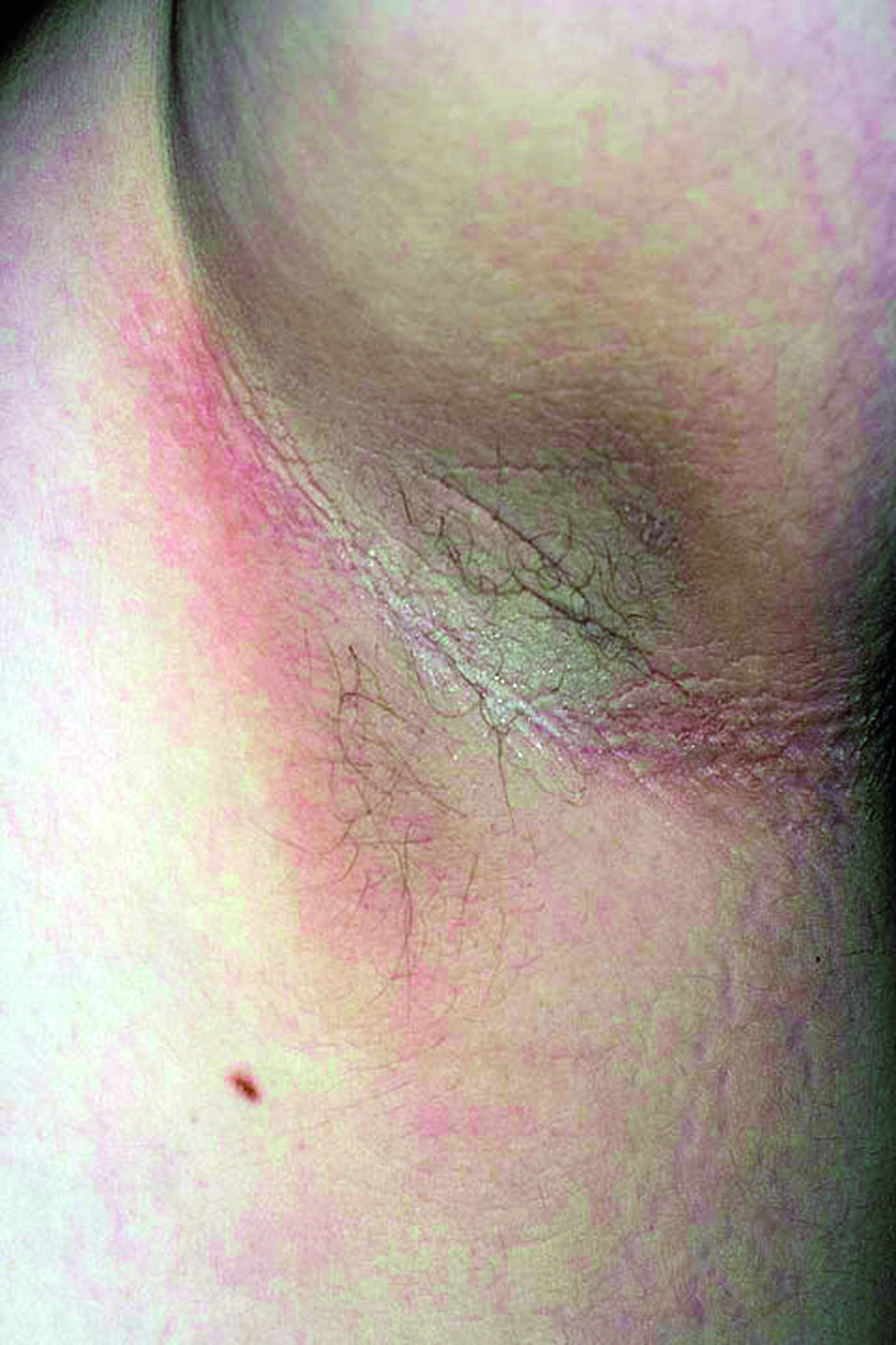 Eine flächige Hyperpigmentierung und Hyperkeratose kennzeichnen die Acanthosis nigricans.