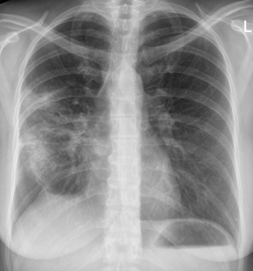 In 8 % der Fälle geht die ambulant behandelte Pneumonie doch stationär