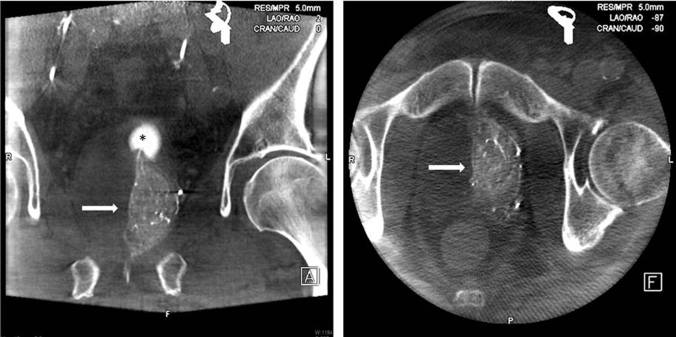 Unmittelbar vor der Embolisation wird mittels CT überprüft, ob der Katheter richtig liegt und die Prostata kontrastiert.