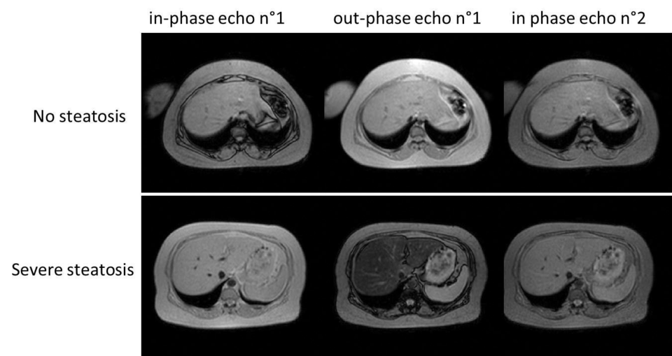 Multiecho-MR-Bilder bei einer gesunden Leber (obere Reihe) und einer Leber mit schwerer Steatose (untere Reihe). 