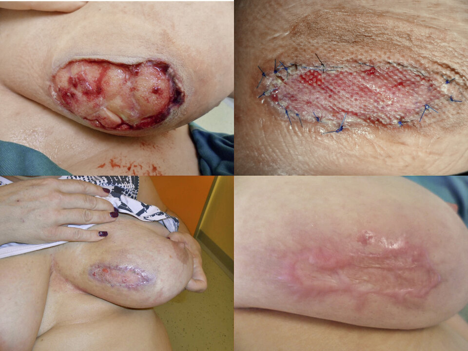 Abb. 9: Pyoderma gangraenosum, Verlauf nach Meshgraft-Transplantation.