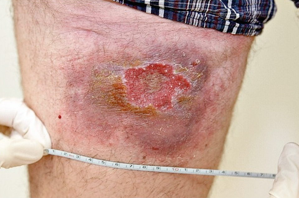 Nach zehn Jahren wurde die Leishmaniasis wieder aktiv. Der Grund war eine immunsupprimierende Psoriasis-Therapie. An der ursprünglichen Infektionsstelle bildete sich eine erythematöse, bläuliche Plaque (11 x 8 cm) mit nässendem zentralem Ulkus auf 4,5 x 3 cm.