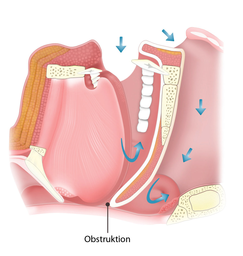 Um die Blockade im  Rachenraum und damit die gestörte Atmung (Pfeile) zu verhindern, müssen Äste des N. hypoglossus stimuliert werden.