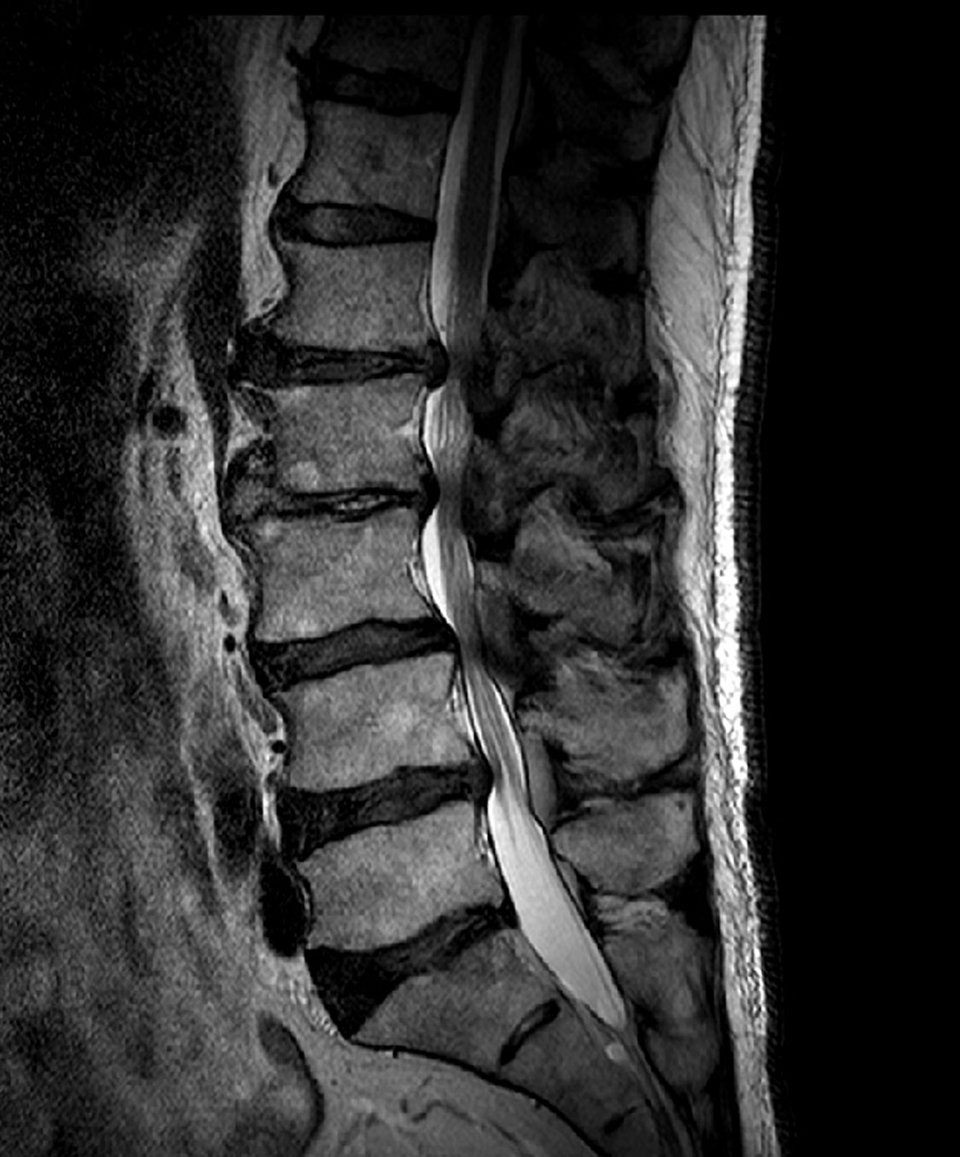 Bisegmentale Spinalstenose auf Höhe LWK 2/3 und LWK 3/4. Ursache ist jeweils ein Diskusprolaps. Beide Ligamenta flava sind hypertroph.