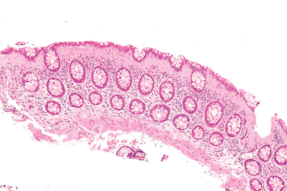 Bei der mikroskopischen Colitis tummeln sich Lymphozyten im Mukosaepithel. Ursache ist vermutlich eine Autoimmunreaktion.