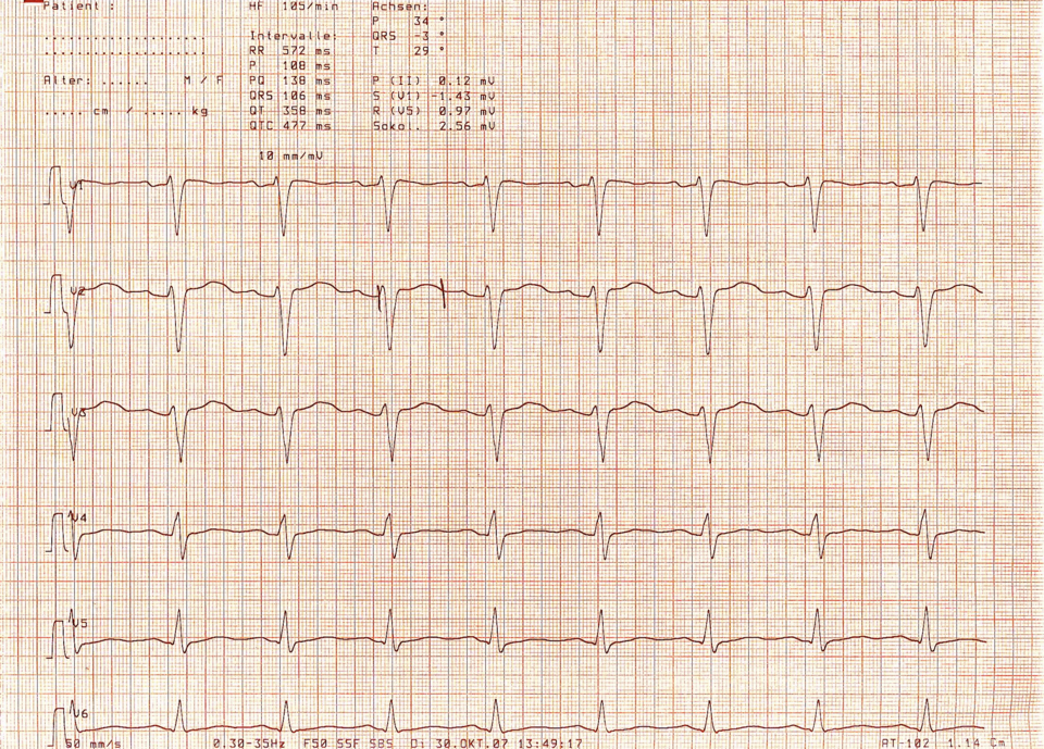 EKG mit verlängerter QT-Zeit