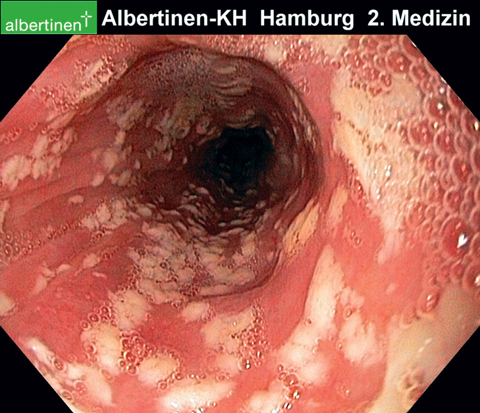 Bei der Soor-Ösophagitis muss generell systemisch  therapiert werden.