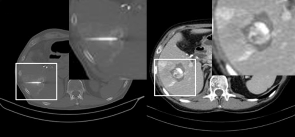 Ist keine Resektion möglich, lässt sich das Tumorgewebe mit einer Kombination aus einer transarteriellen Chemoembolisation und Radiofrequenzablation (links) zerstören (rechts).