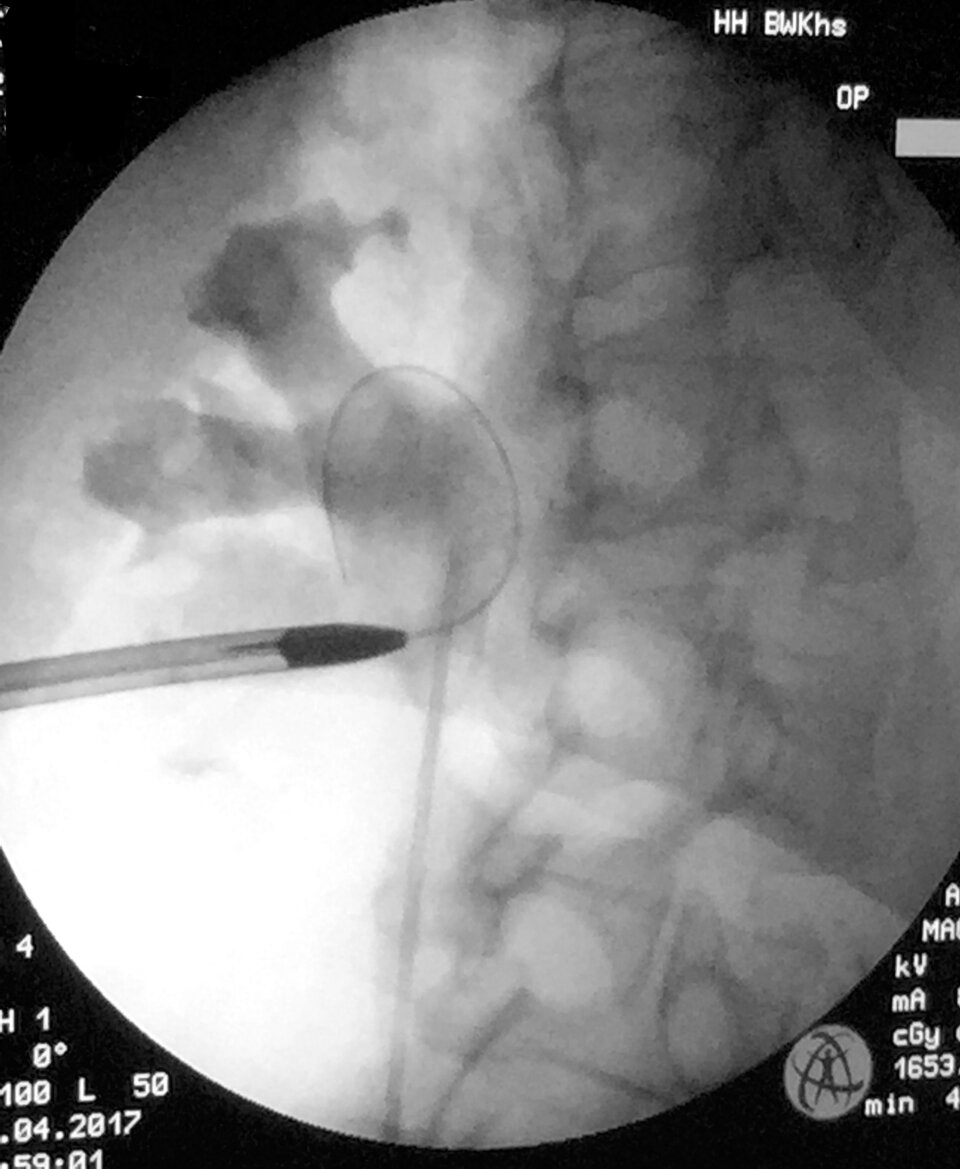 Bei der perkutanen Nephrolithotomie punktiert man die Niere durch die Haut.