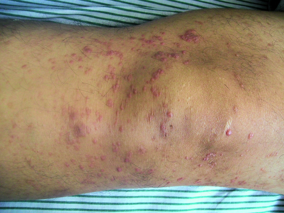 Auch dieser 52-Jährige dachte wohl an einen simplen Ausschlag am Knie, litt aber an einer Mycosis fungoides.