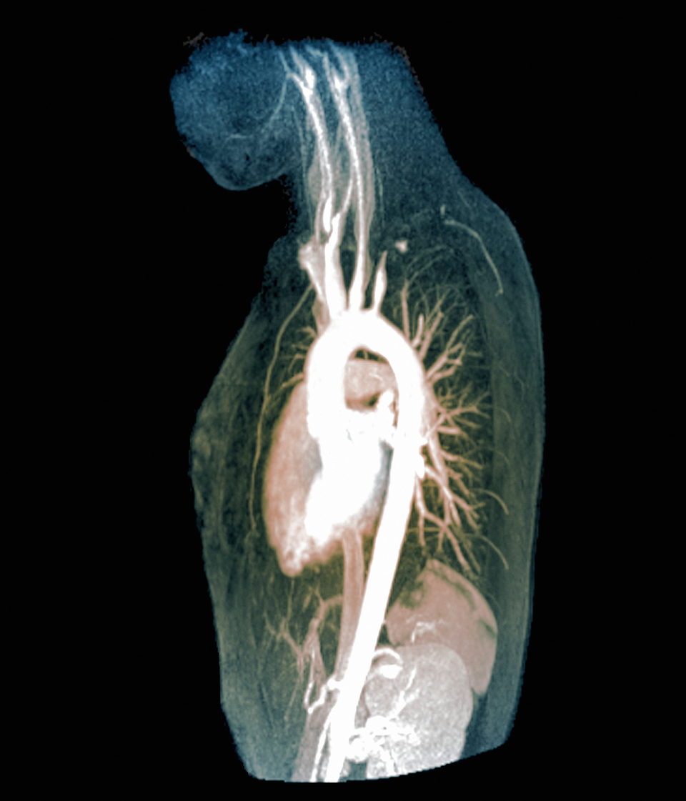 Im MR-Scan einer 16-Jährigen mit Takayasu Arteriitis ist eine verdickte Wand der Aorta ascendens zu erkennen. Zudem hat ein Thrombus die linke Arteria subclavia verstopft.