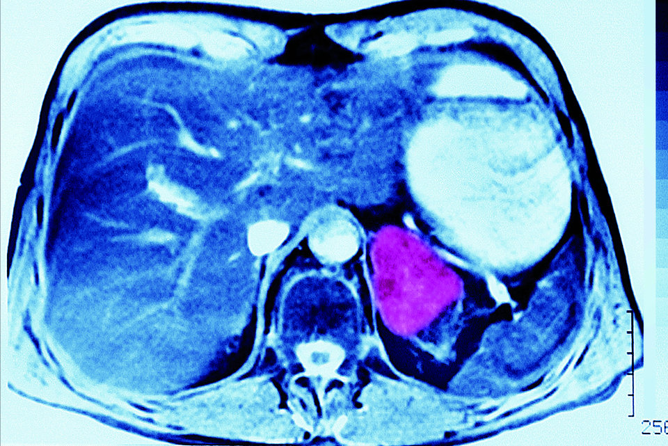 Die allermeisten Karzinome sind bei der Diagnose > 4 cm. Jedoch sind auch viele Inzidentalome mit > 4 cm gutartig. Dieser hier erwies sich als maligne.