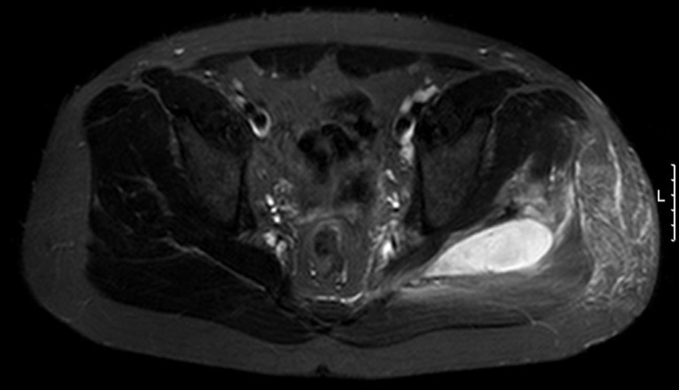 Eine Ischialgie führte diesen Patienten zum Arzt. Im MRT fand sich eine gluteale Pyo­myositis inklusive eines Abszesses.